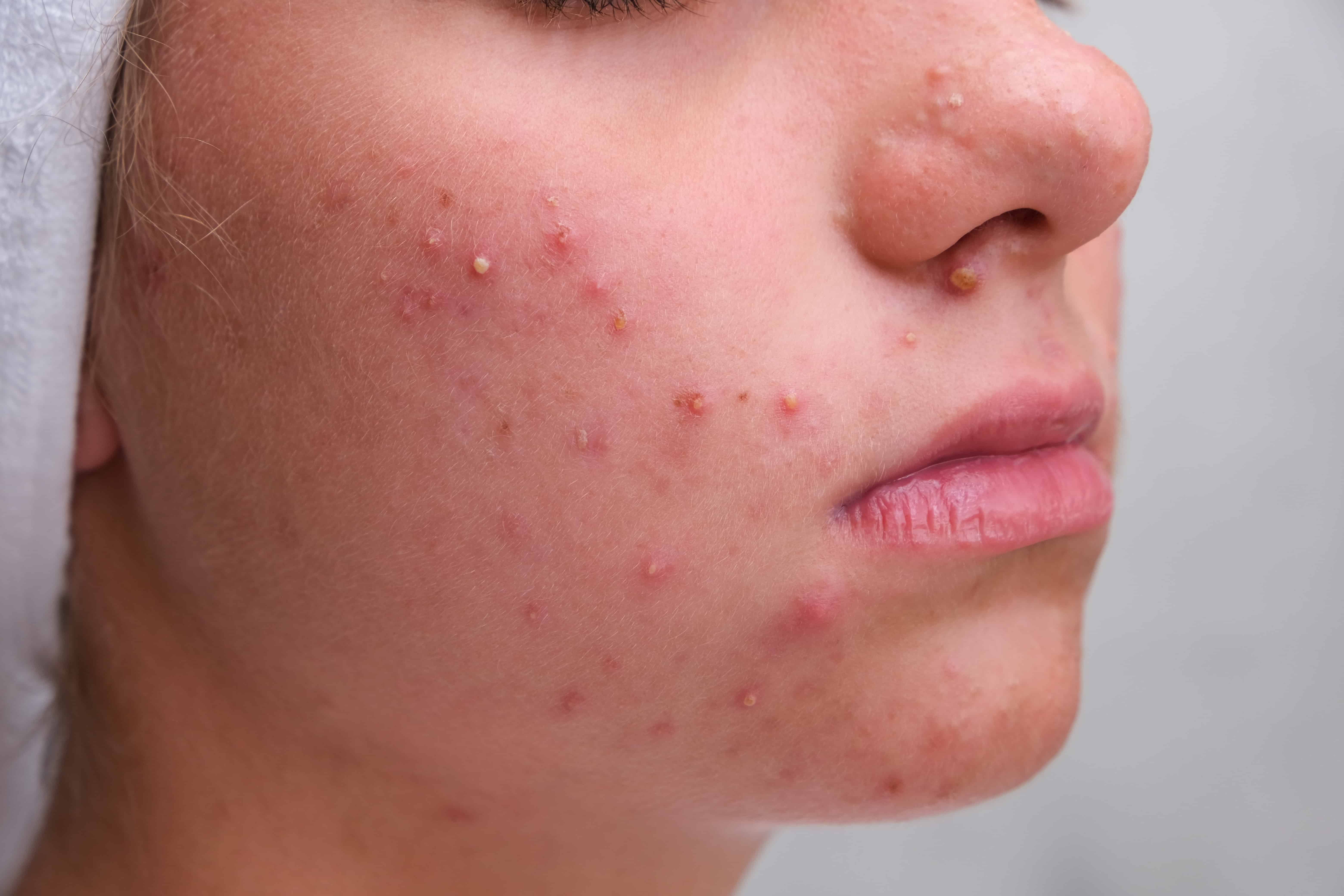 Acne Scar Treatment in Delhi